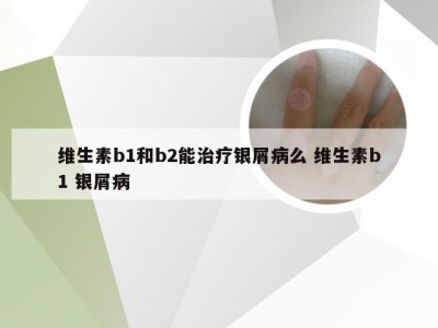 维生素b1和b2能治疗银屑病么 维生素b1 银屑病