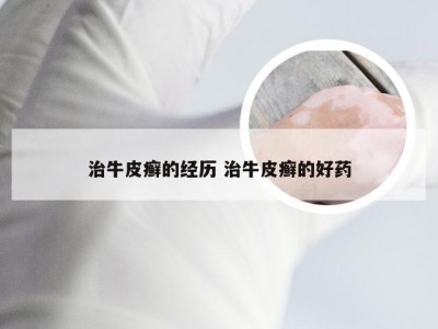治牛皮癣的经历 治牛皮癣的好药