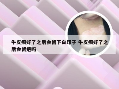 牛皮癣好了之后会留下白印子 牛皮癣好了之后会留疤吗