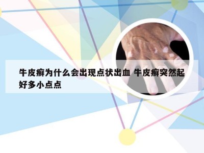 牛皮癣为什么会出现点状出血 牛皮癣突然起好多小点点