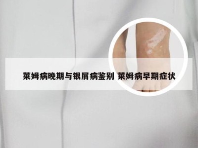 莱姆病晚期与银屑病鉴别 莱姆病早期症状