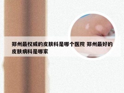 郑州最权威的皮肤科是哪个医院 郑州最好的皮肤病科是哪家