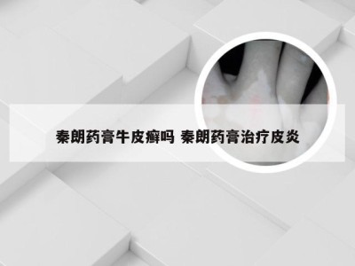 秦朗药膏牛皮癣吗 秦朗药膏治疗皮炎
