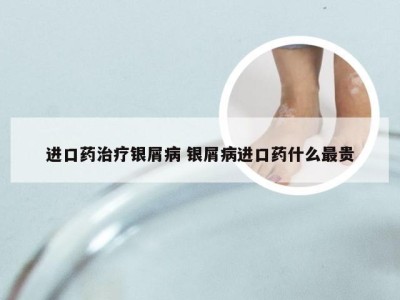 进口药治疗银屑病 银屑病进口药什么最贵