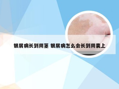 银屑病长到阴茎 银屑病怎么会长到阴囊上