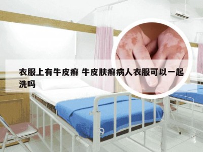 衣服上有牛皮癣 牛皮肤癣病人衣服可以一起洗吗