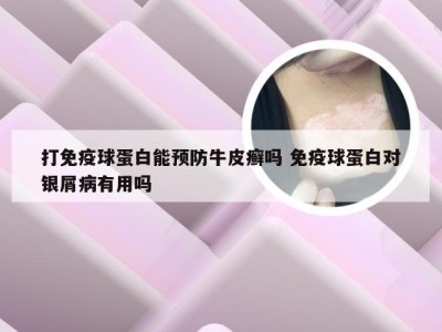 打免疫球蛋白能预防牛皮癣吗 免疫球蛋白对银屑病有用吗