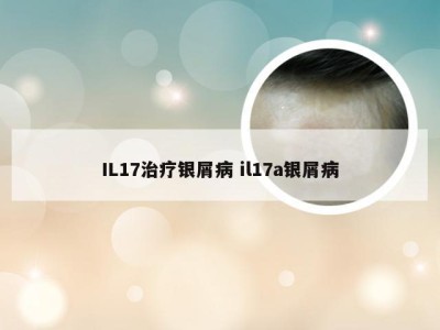 IL17治疗银屑病 il17a银屑病