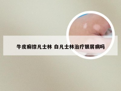 牛皮癣捺凡士林 白凡士林治疗银屑病吗