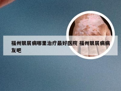 福州银屑病哪里治疗最好医院 福州银屑病病友吧