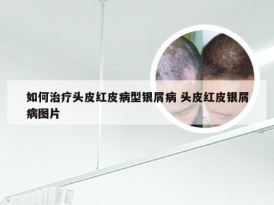 如何治疗头皮红皮病型银屑病 头皮红皮银屑病图片