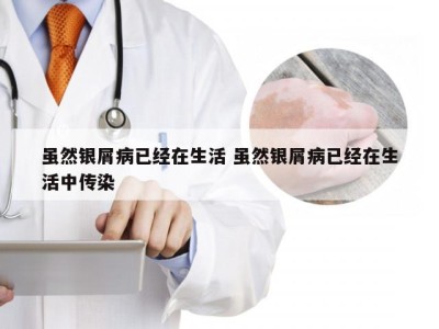 虽然银屑病已经在生活 虽然银屑病已经在生活中传染