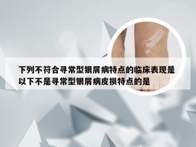 下列不符合寻常型银屑病特点的临床表现是 以下不是寻常型银屑病皮损特点的是