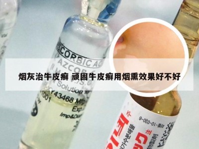 烟灰治牛皮癣 顽固牛皮癣用烟熏效果好不好