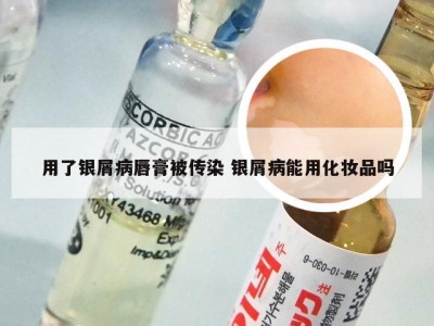 用了银屑病唇膏被传染 银屑病能用化妆品吗