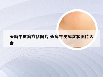 头癣牛皮癣症状图片 头癣牛皮癣症状图片大全