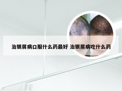 治银屑病口服什么药最好 治银屑病吃什么药