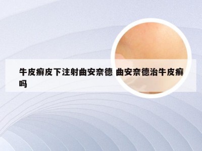 牛皮癣皮下注射曲安奈德 曲安奈德治牛皮癣吗