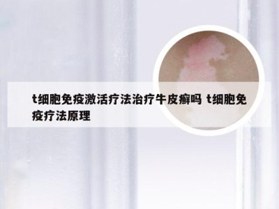 t细胞免疫激活疗法治疗牛皮癣吗 t细胞免疫疗法原理