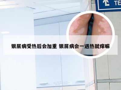 银屑病受热后会加重 银屑病会一遇热就痒嘛