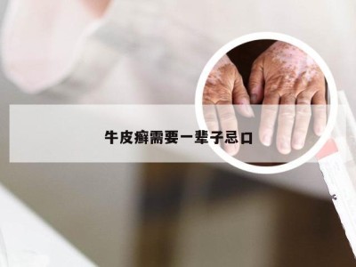 牛皮癣需要一辈子忌口