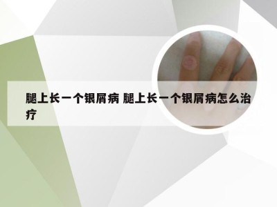 腿上长一个银屑病 腿上长一个银屑病怎么治疗