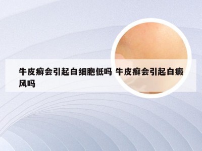 牛皮癣会引起白细胞低吗 牛皮癣会引起白癜风吗