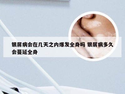 银屑病会在几天之内爆发全身吗 银屑病多久会蔓延全身