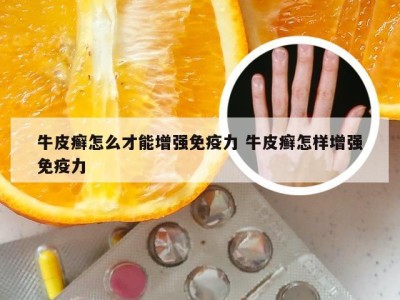 牛皮癣怎么才能增强免疫力 牛皮癣怎样增强免疫力