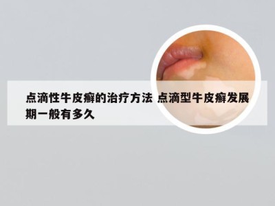 点滴性牛皮癣的治疗方法 点滴型牛皮癣发展期一般有多久