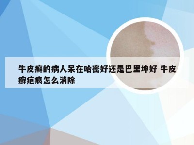 牛皮癣的病人呆在哈密好还是巴里坤好 牛皮癣疤痕怎么消除