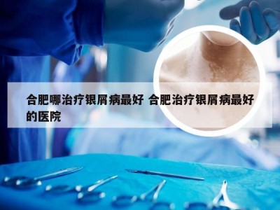 合肥哪治疗银屑病最好 合肥治疗银屑病最好的医院