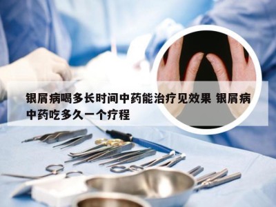 银屑病喝多长时间中药能治疗见效果 银屑病中药吃多久一个疗程