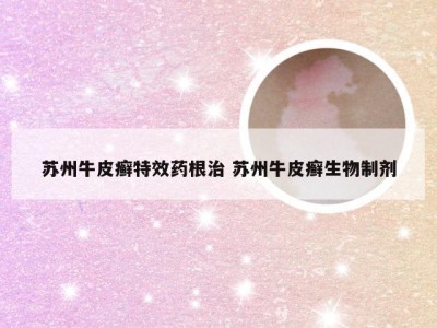 苏州牛皮癣特效药根治 苏州牛皮癣生物制剂