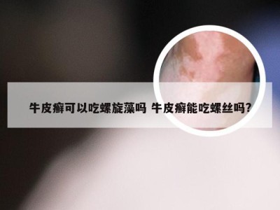 牛皮癣可以吃螺旋藻吗 牛皮癣能吃螺丝吗?