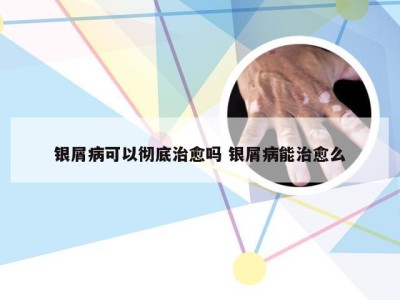 银屑病可以彻底治愈吗 银屑病能治愈么