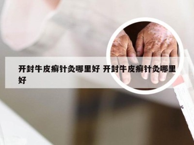 开封牛皮癣针灸哪里好 开封牛皮癣针灸哪里好