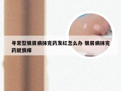 寻常型银屑病抹完药发红怎么办 银屑病抹完药就很痒