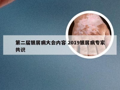 第二届银屑病大会内容 2019银屑病专家共识