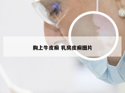 胸上牛皮癣 乳房皮癣图片