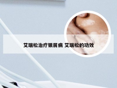 艾瑞松治疗银屑病 艾瑞松的功效