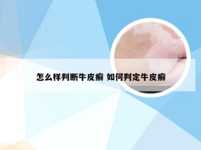 怎么样判断牛皮癣 如何判定牛皮癣