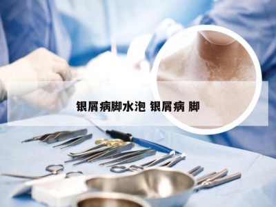 银屑病脚水泡 银屑病 脚
