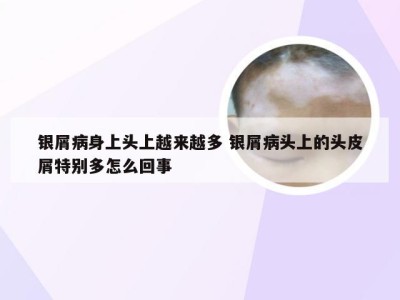 银屑病身上头上越来越多 银屑病头上的头皮屑特别多怎么回事