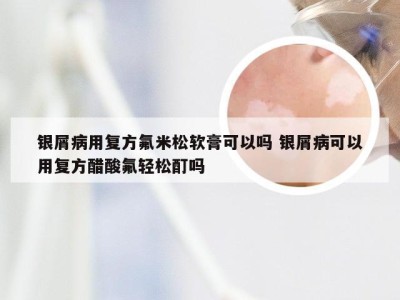 银屑病用复方氟米松软膏可以吗 银屑病可以用复方醋酸氟轻松酊吗
