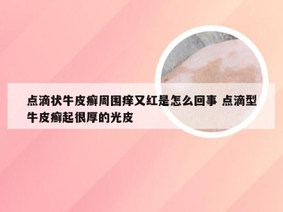 点滴状牛皮癣周围痒又红是怎么回事 点滴型牛皮癣起很厚的光皮