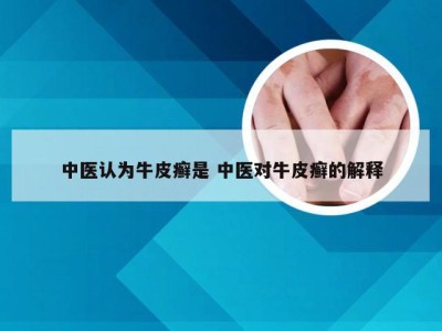 中医认为牛皮癣是 中医对牛皮癣的解释