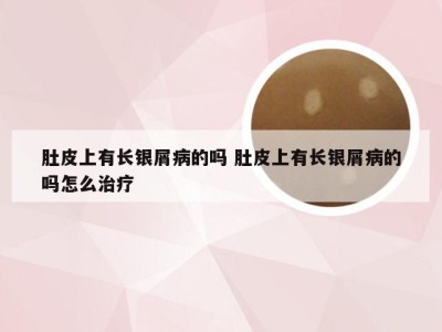 肚皮上有长银屑病的吗 肚皮上有长银屑病的吗怎么治疗