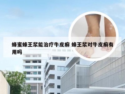 蜂蜜蜂王浆能治疗牛皮癣 蜂王浆对牛皮癣有用吗
