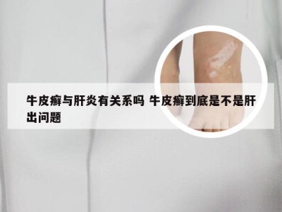 牛皮癣与肝炎有关系吗 牛皮癣到底是不是肝出问题